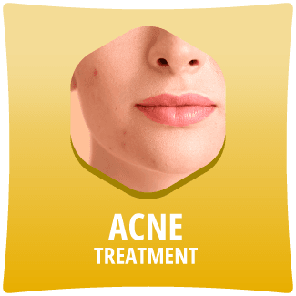 acne