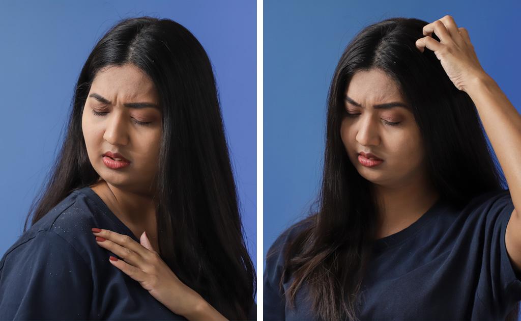 ড্যানড্রাফ নাকি ড্রাই স্ক্যাল্প – আপনি কোন সমস্যায় ভুগছেন?