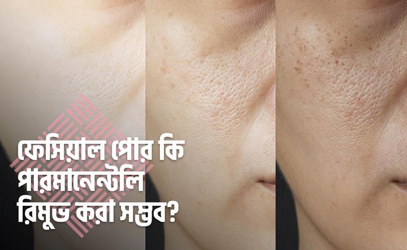 ফেসিয়াল পোর কি পারমানেন্টলি রিমুভ করা সম্ভব?